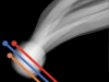 Electric field sensors for ESA’s Comet Interceptor mission 