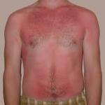 Sunburn